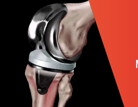 THE PERFECT KNEE Novità in tema di protesi di ginocchio